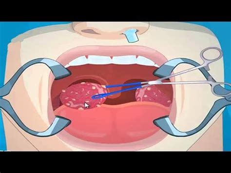Tonsil Removal Surgery Tonsillectomy Youtube
