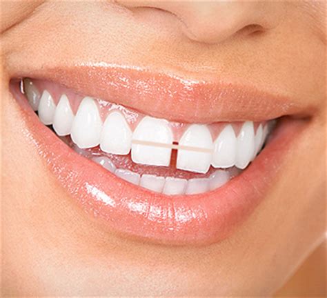 So, every tooth has to shift you can find a lot of cheap teeth bands and diy braces. Teeth Gap Bands - Close Gapped Teeth