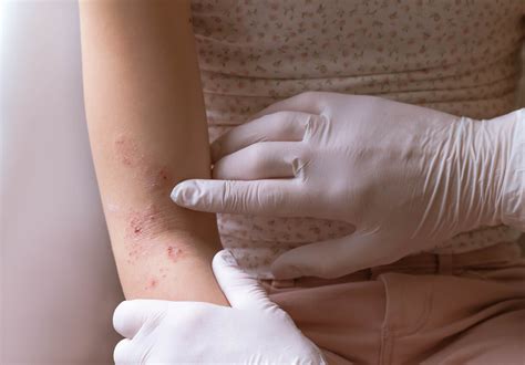 Most Common Skin Rashes Among Adults Georgia Skin Cancer And My Xxx