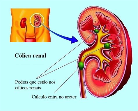 Infeccao De Urina Da Colicas