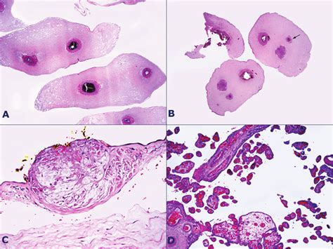 Pathological Findings Of The Placenta In The Territory Of The Twin 2