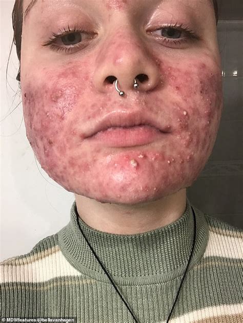 Woman Whose Cystic Acne Left Her In Extreme Pain And Suicidal Finds Life Changing Treatment