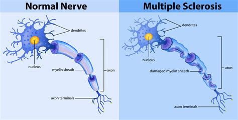 Multiple sclerosis (ms), also known as encephalomyelitis disseminata, is a demyelinating disease in which the insulating covers of nerve cells in the brain and spinal cord are damaged. Normal nerve and multiple sclerosis 294059 Vector Art at ...