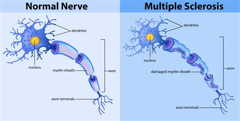 Multiple sklerose (ms) ist eine chronische erkrankung des zentralen nervensystems (zns). Normal nerve and multiple sclerosis 294059 Vector Art at ...