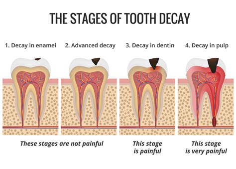 Tooth Cavities Vistasol Dental