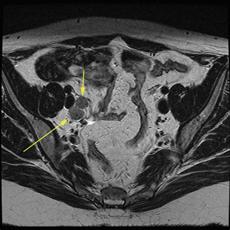 Imaging Of Lymph Node Metastases In Cervical Cancer Cmaj