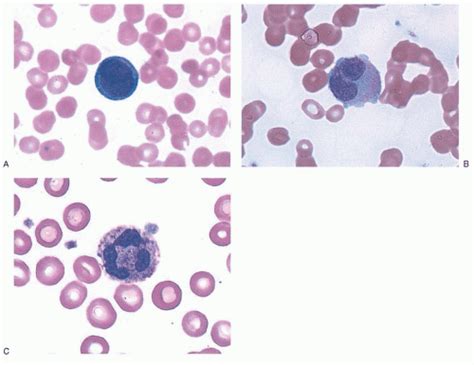 Acute Promyelocytic Leukemia Oncohema Key