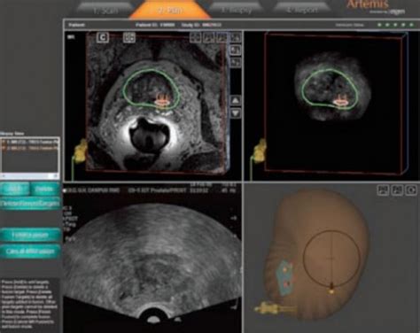 Transrectal Ultrasound Prostate Biopsy