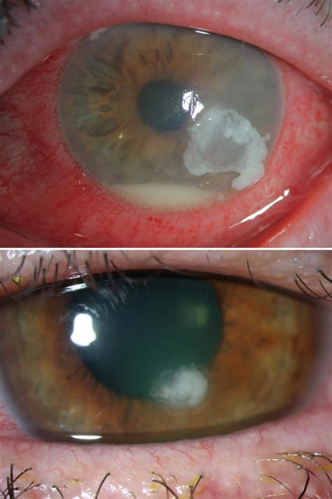 Corneal Ulcer Symptoms Causes And Treatment