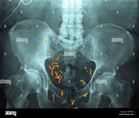 Abdomen X Ray Showing Surgery For Bladder Cancer Stock Photo Alamy