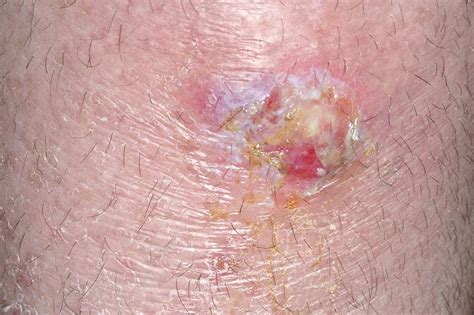 Slike Infekcije Stafilokokom Na Koži Njega Kože Slideshow