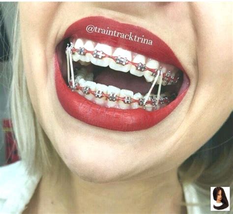 Braces That Make Your Teeth Look Whiter Find Property To Rent