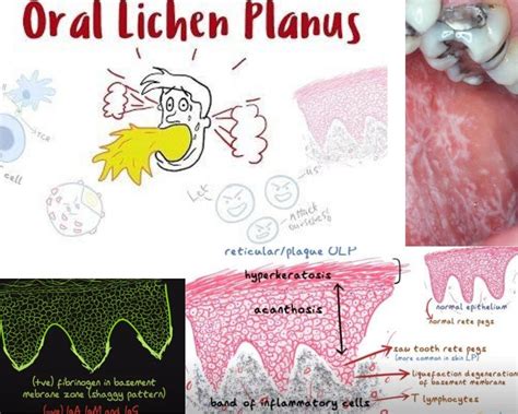 Salivary Cytokines Effective And Effortless Diagnosis Of Oral Lichen