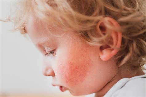 Dermatite Atopica Nei Bambini Primi Dati Positivi Per Il JAK Inib