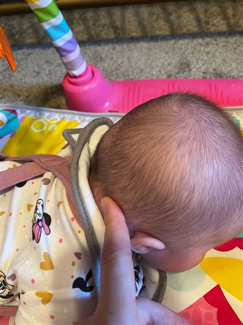 Lump On Back Of Babys Head Babycenter