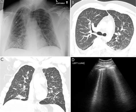 Pulmonary Edema On Lung Us A Anteroposterior Chest Radiograph Shows