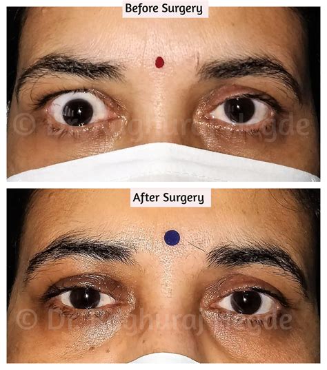 Eyelid Dr Raghuraj Hegde