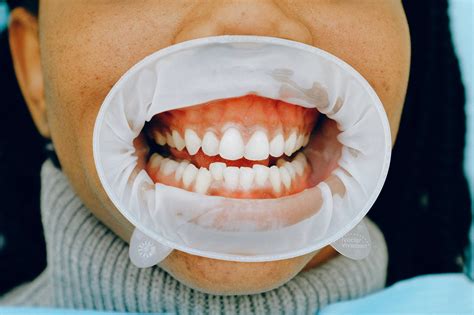 Gum Diseases May Also Be An Outcome Of The New Wave Of Covid 19