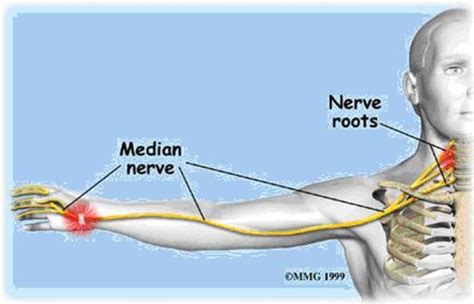The median nerve is a nerve in humans and other animals in the upper limb. Studio 5 - Health and Wellness: Carpal Tunnel Syndrome