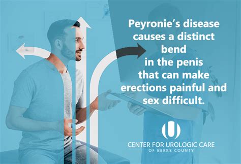 Peyronie’s Disease Center For Urologic Care Of Berks County