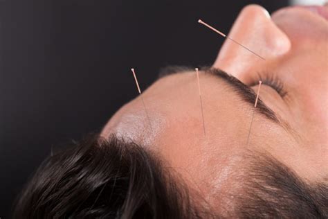 Acupuncture Reduces Pain Intensity In Idiopathic Trigeminal Neuralgia