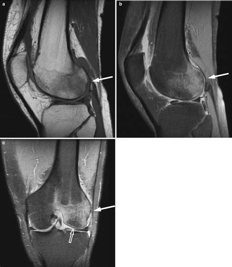 Bone Marrow Edema Pattern Radiology Key