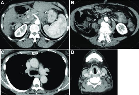 At 21 Months Lymphadenopathies Were Noted Around The Abdominal Aorta
