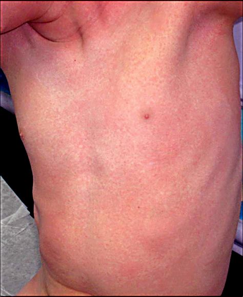 Numbered Diseases Of Childhood Rashes
