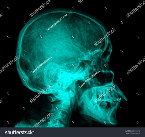 Film Xray Skull Lateral Stock Photo 232255618 Shutterstock