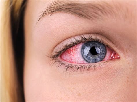 Red And Bloodshot Eyes Common Causes And Remedies