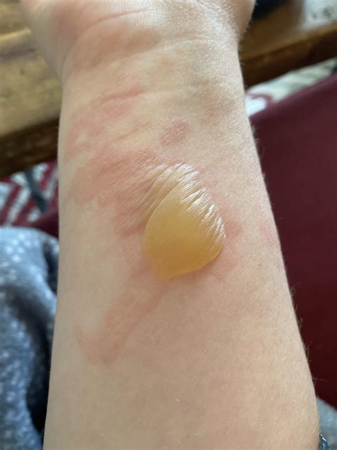 Burn Blisterthe Most Forbidden Pop I Have Ever Had 😖 Rpopping