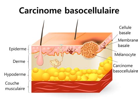 Carcinome Définition Symptômes Traitements