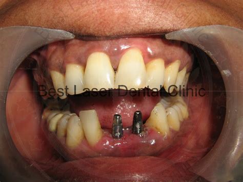 Gallery 3 Quake Denture Replaced With Fixed Teeth With The Help Of