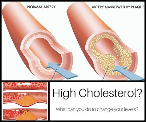 People can have different responses to the same medicine, so your results may vary. Everything You Need To Know About High Cholesterol ...