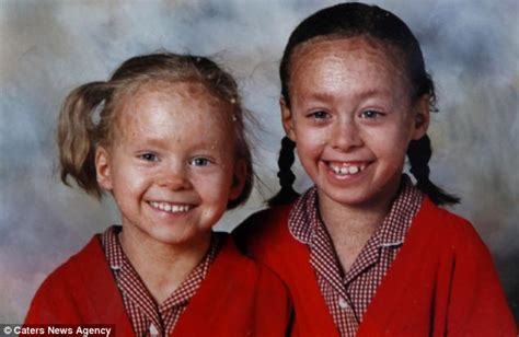 Lamellar Ichthyosisthe Teenage Sisters Who Shed All Their Skin Every