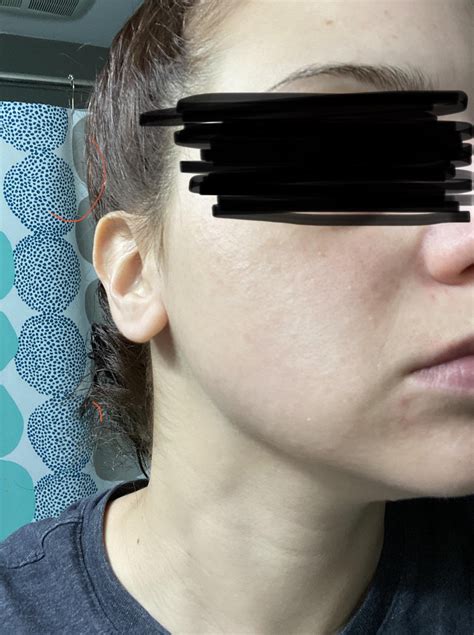 Skin Concern Bumps On Cheeks Skincareaddiction