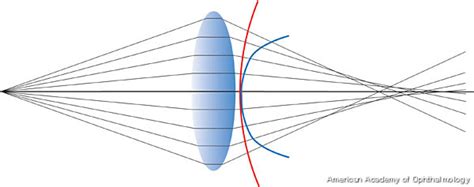 Spherical aberration. - American Academy of Ophthalmology