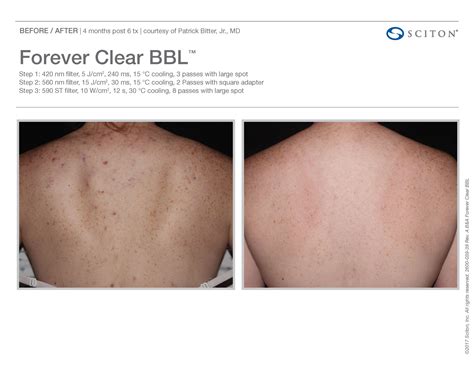 Forever Clear Acne Treatment St Louis Mo Marelyse Medispa