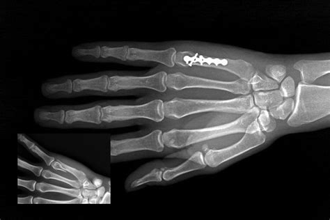 Little Metacarpal Fracture Hand Surgery Source