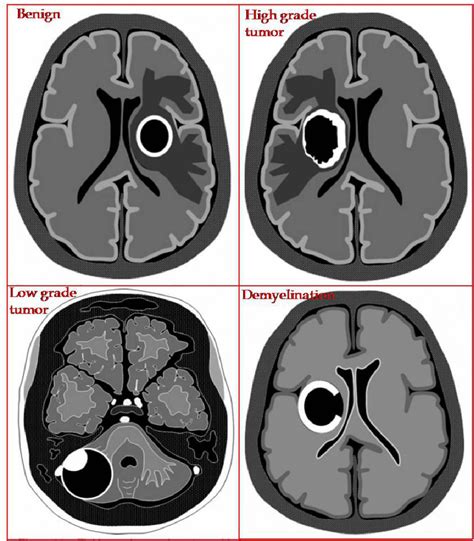 Figure 2 From Differential Diagnosis Of Ring Enhancing Lesions In