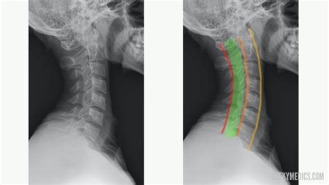 Cervical Spine X Ray Interpretation Osce Guide Geeky Medics