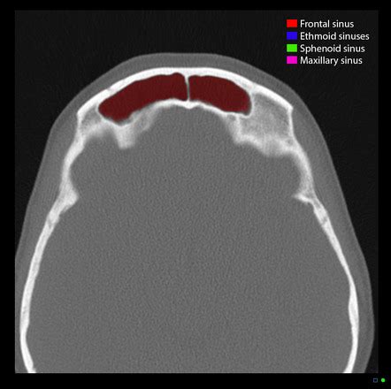 Frontal Sinus Radiology Reference Article Radiopaedia Org