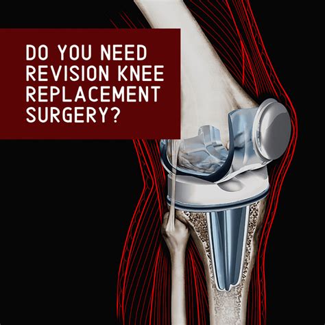 Do You Need Revision Knee Replacement Surgery Orthopaedic Institute