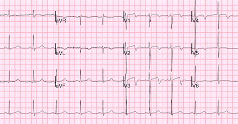 Dr Smith S ECG Blog Wellens Waves Are NOT Equivalent To Wellens
