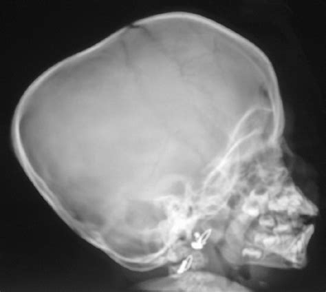 Separation of the upper lateral cartilage: Combined mucopolysaccharidosis type VI and congenital ...