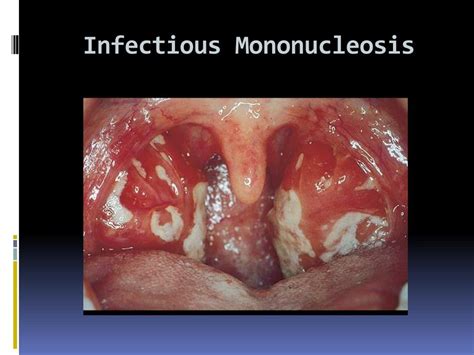 The study illustrates that the surfaces of tonsils of patients with infectious mononucleosis contain more species of anaerobic organisms during the illness than following it. PPT - Adenotonsillar disease PowerPoint Presentation, free ...