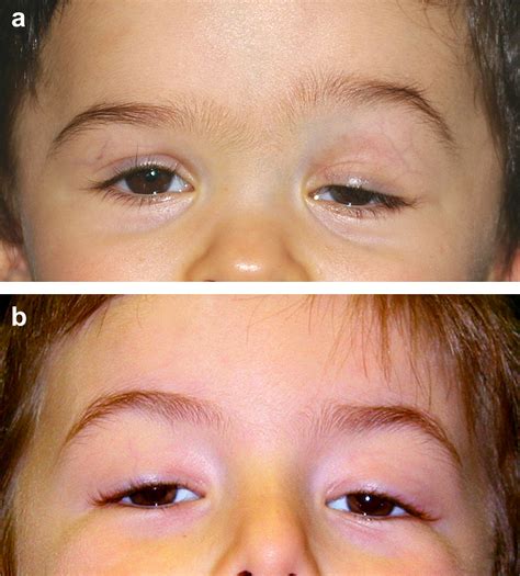 Congenital Ptosis Long Term Outcome Of Frontalis Suspension Using