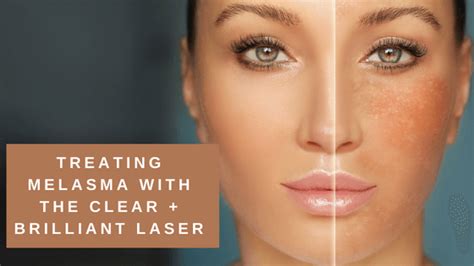 How Does The Clear Brilliant Laser Facial Compare To Microneedling