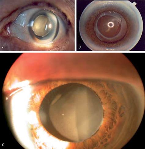 A Total Opacification Of An IOL From A Patient Without Any Ocular Or