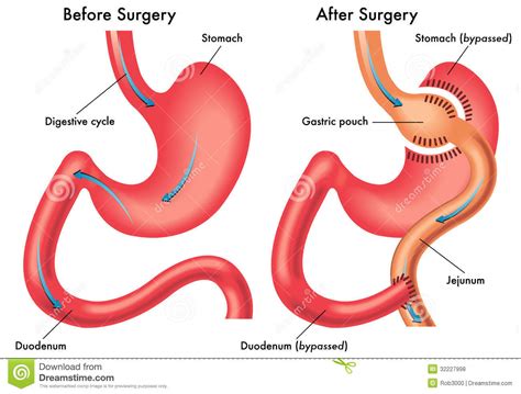 Gastric Bypass Stock Vector Illustration Of Duodenum 32227998